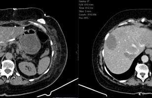 Augusta Victoria Hospital in a notable step in Cancer Care in Palestine