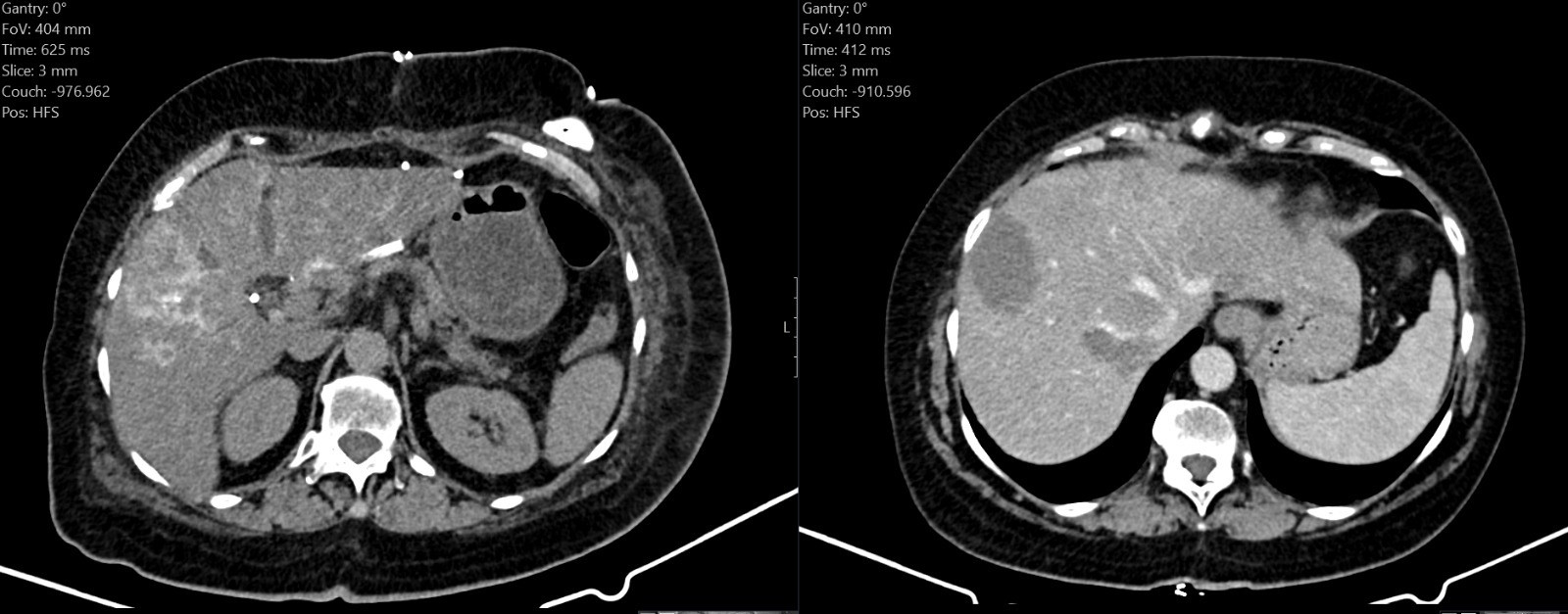 Augusta Victoria Hospital in a notable step in Cancer Care in Palestine